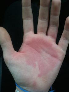 hand swelling1