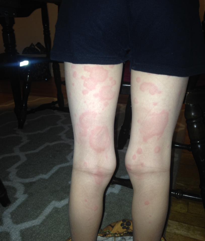My 7 year old son has been experiencing hives