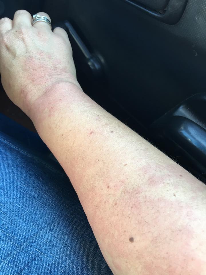 I started getting hives in October 2014