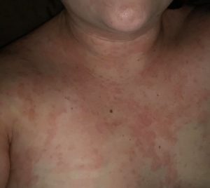 chronic hives since February 2019