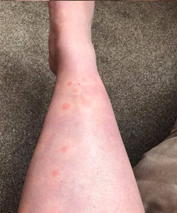 hives on leg1