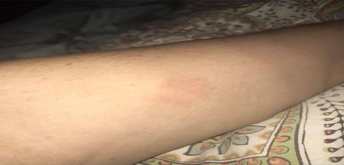 Most of the insect bites i get turn into hives
